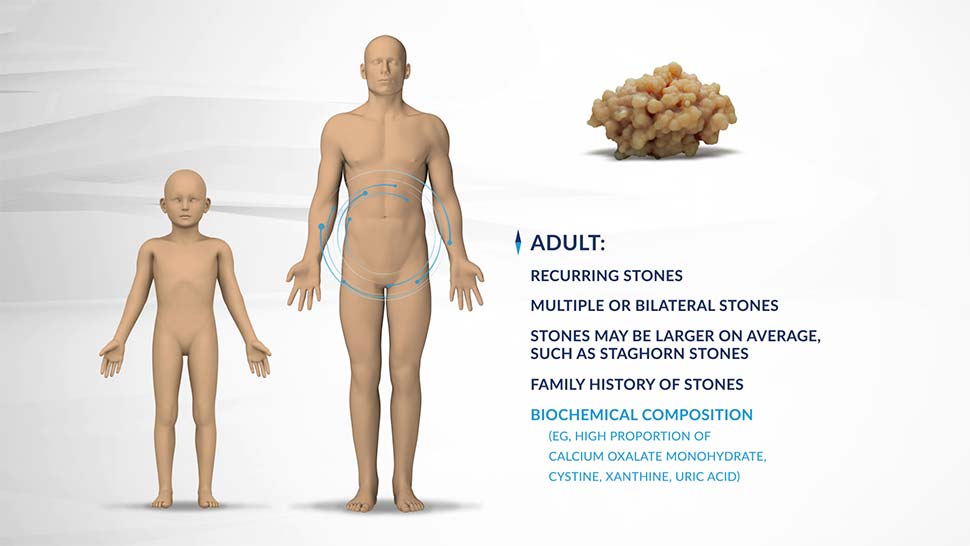 Primary Hyperoxaluria Type 1 (PH1) Mechanism of Disease - Body Figures - Video Thumbnail